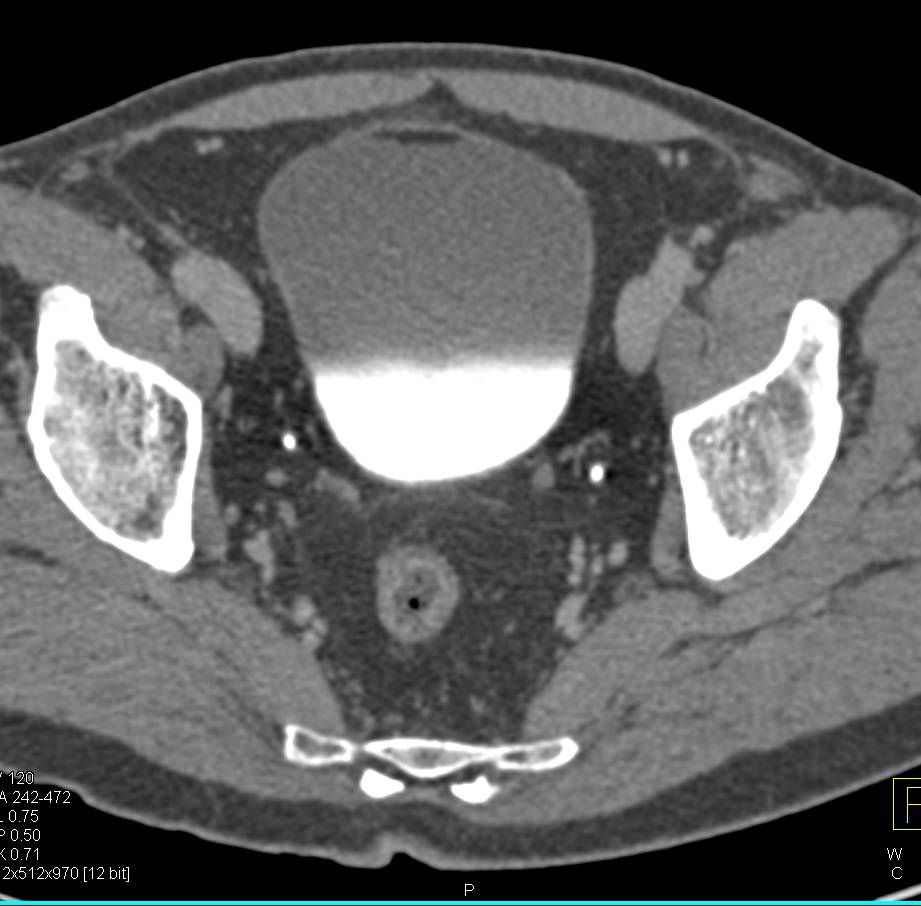 Fat Fluid Level in Bladder Following Laparoscopic Partial Nephrectomy Surgery Representing Injury to Lymphatics - CTisus CT Scan