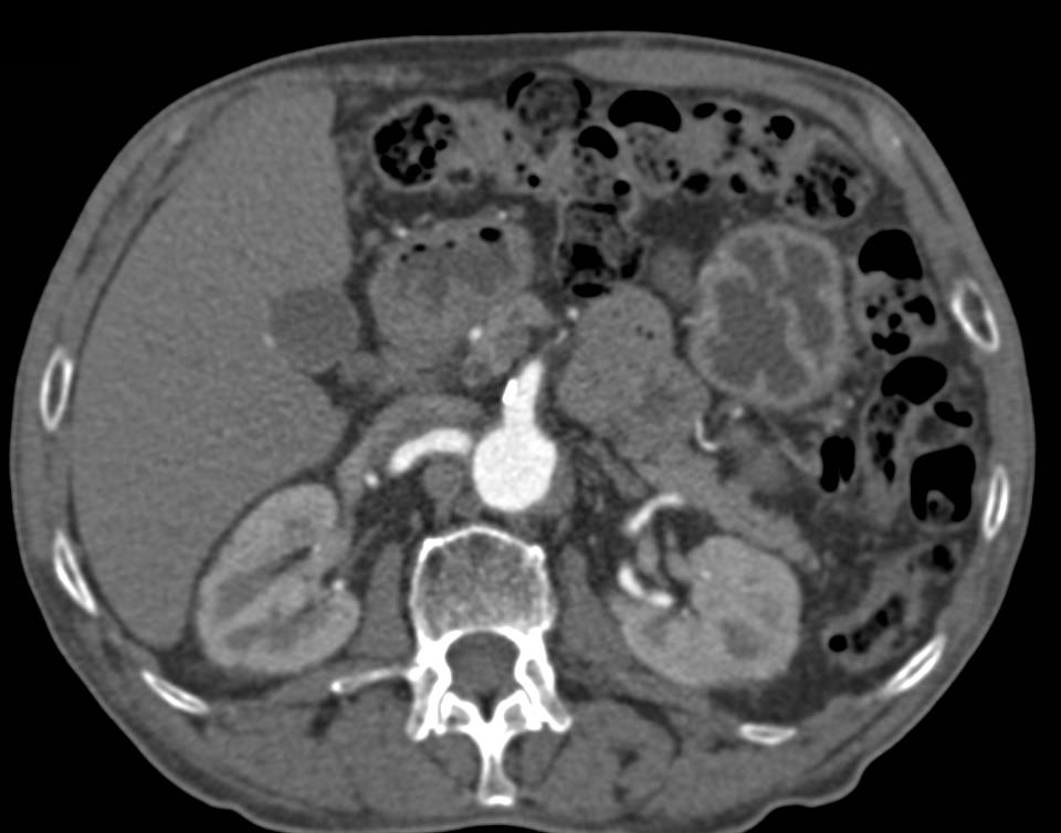 Polypoid Bladder Carcinoma - CTisus CT Scan