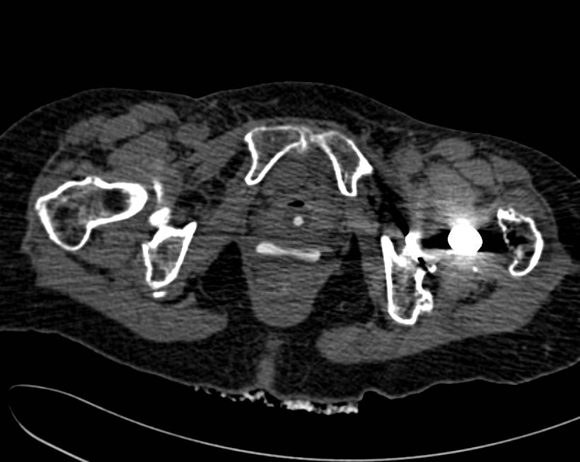 Fistulae Between Bladder and the Rectum - CTisus CT Scan