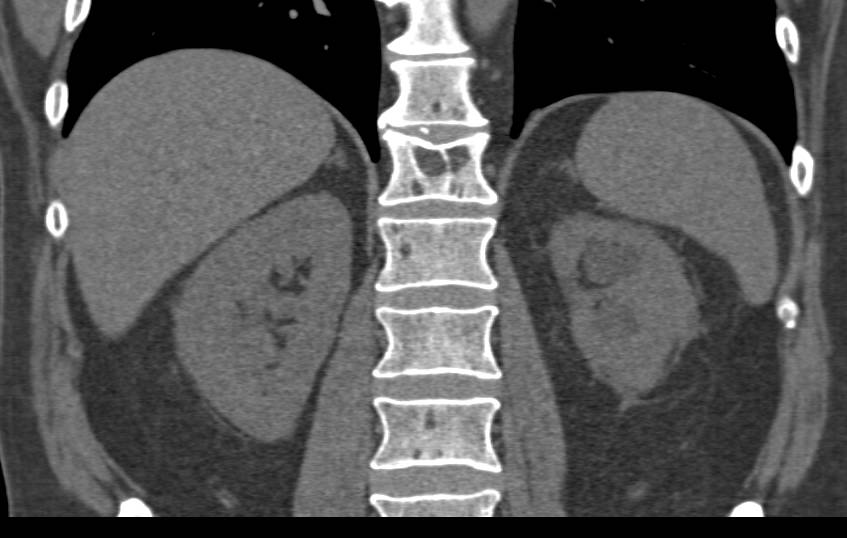 Bladder Cancer Obstructs the Left Ureter - CTisus CT Scan