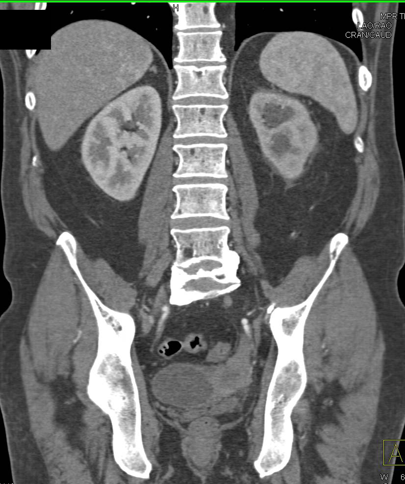 Bladder Cancer Obstructs the Left Ureter - CTisus CT Scan