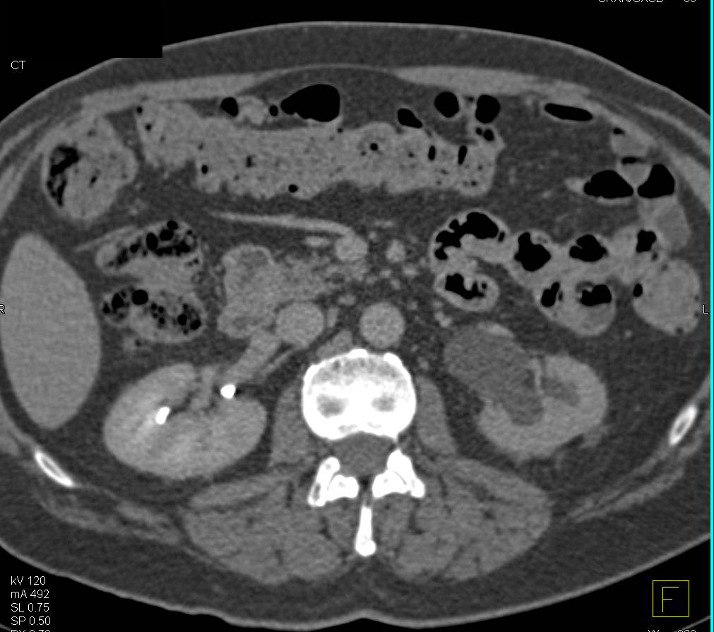 Bladder Cancer Obstructs the Left Ureter - CTisus CT Scan