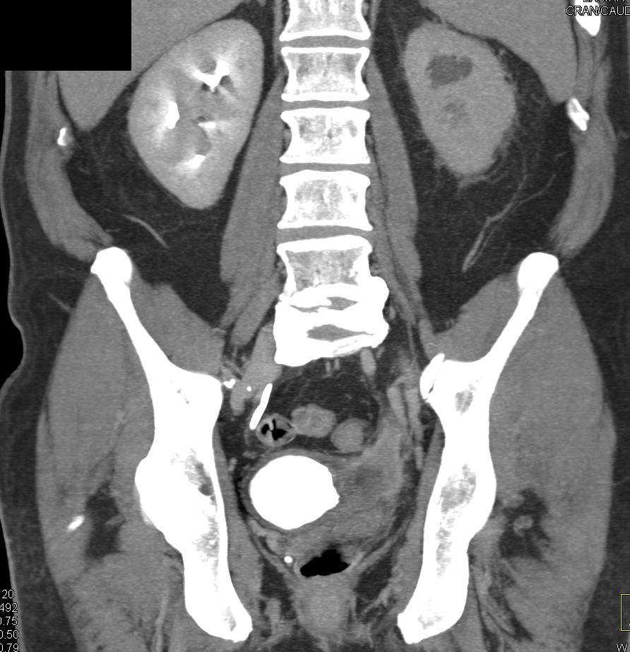 Bladder Cancer, Invasive also Obstructs the Left kidney - CTisus CT Scan