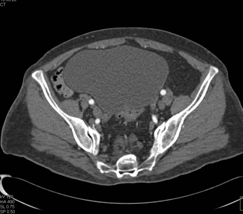 Delayed Bladder Emptying - CTisus CT Scan