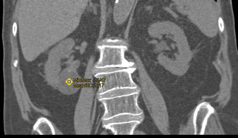 Blood Clots in the Bladder Following Pelvic Surgery - CTisus CT Scan