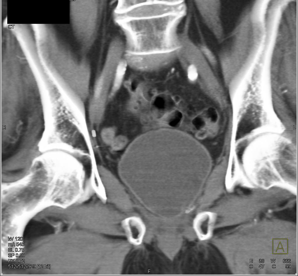 Hematoma Layers out in the Bladder - CTisus CT Scan