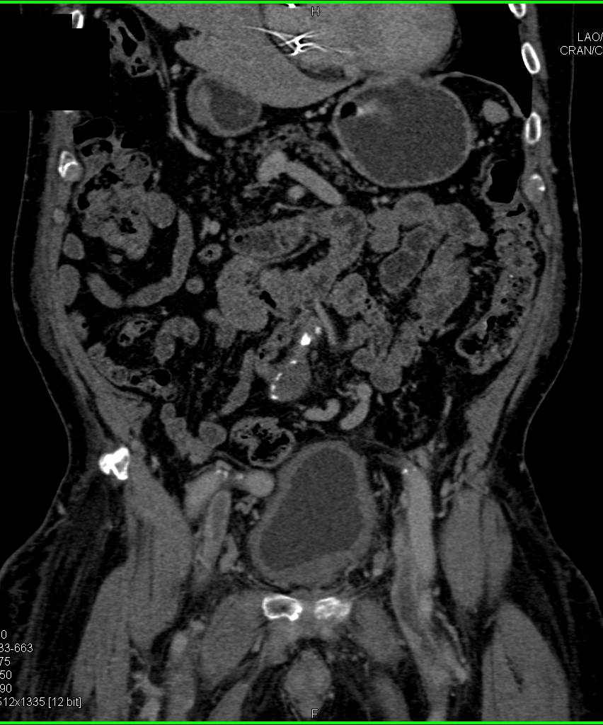 Bladder Cancer - CTisus CT Scan