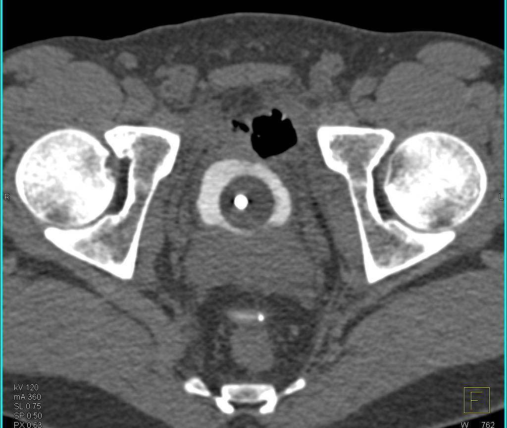 CT Cystogram with Bladder Leak s/p Pelvic Trauma - CTisus CT Scan