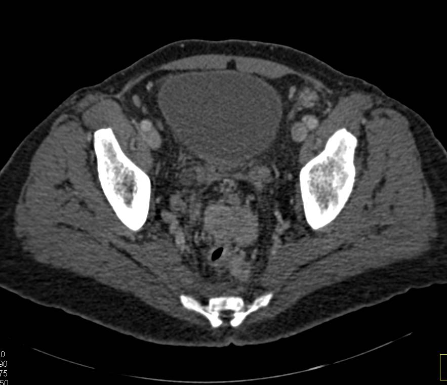 Prostate Cancer with Local Nodes and Bone Metastases - CTisus CT Scan