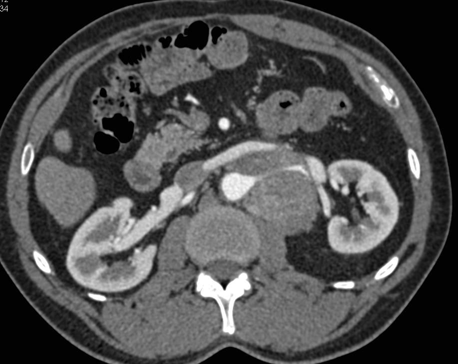 Germ Cell Tumor with Bulky Left Para-aortic Adenopathy - CTisus CT Scan