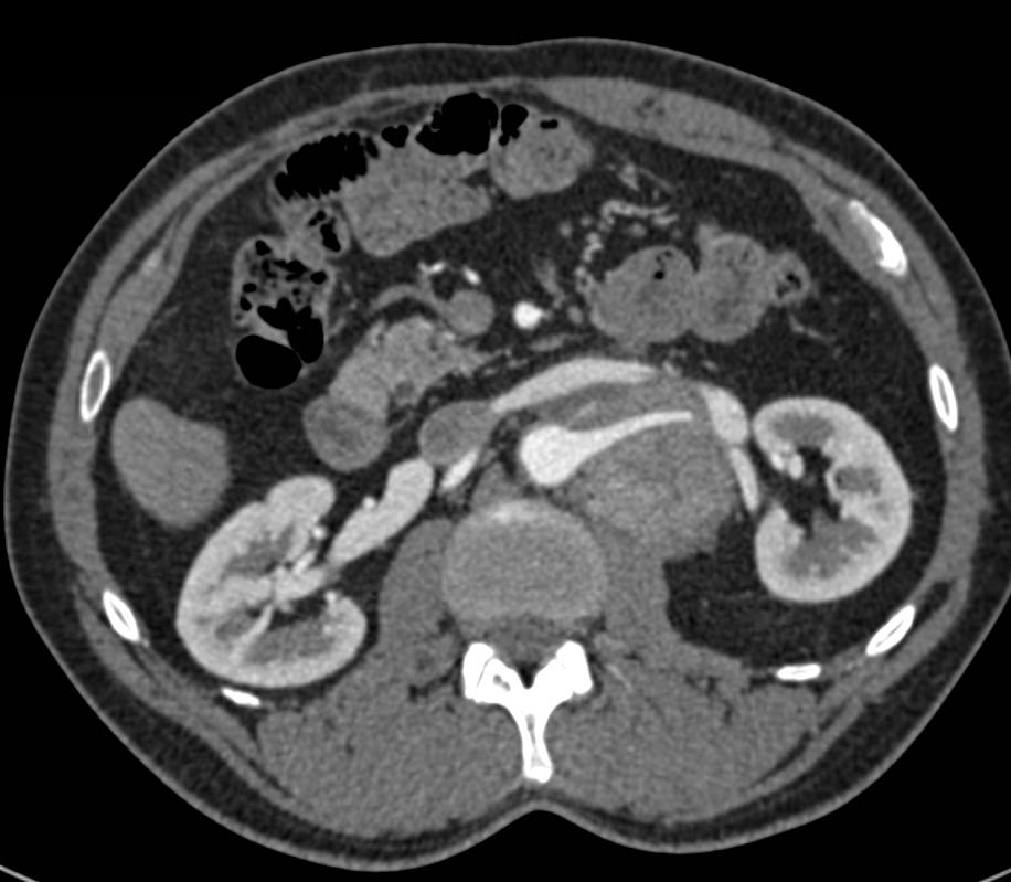 Neuroendocrine Tumor in the Left Para-Aortic Zone - CTisus CT Scan