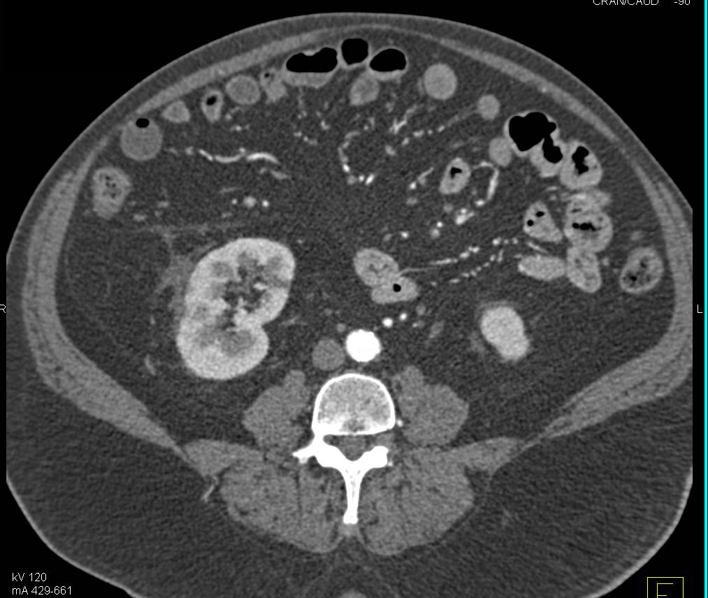 Transitional Cell Cancer (TCC) of the Bladder - CTisus CT Scan