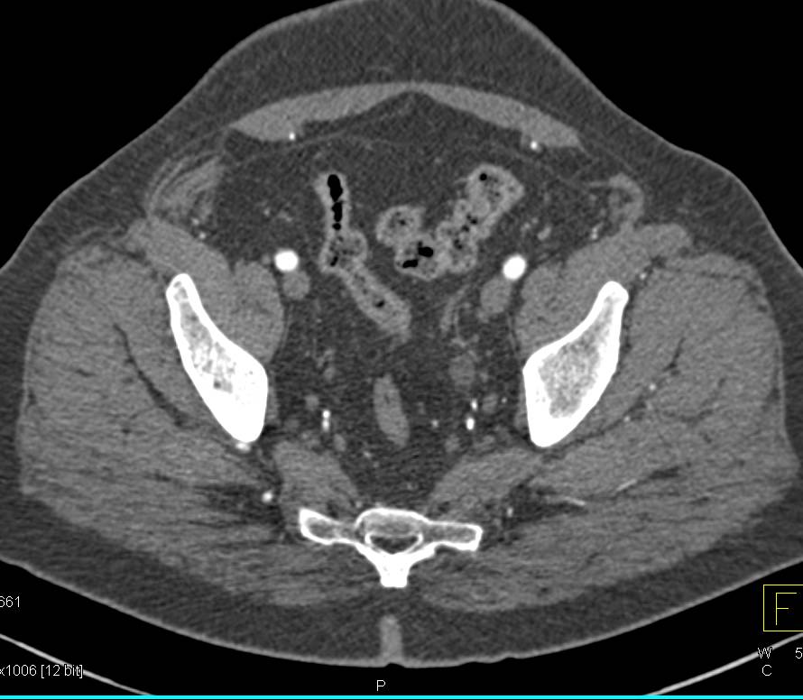 Enhancing Bladder Cancer - CTisus CT Scan