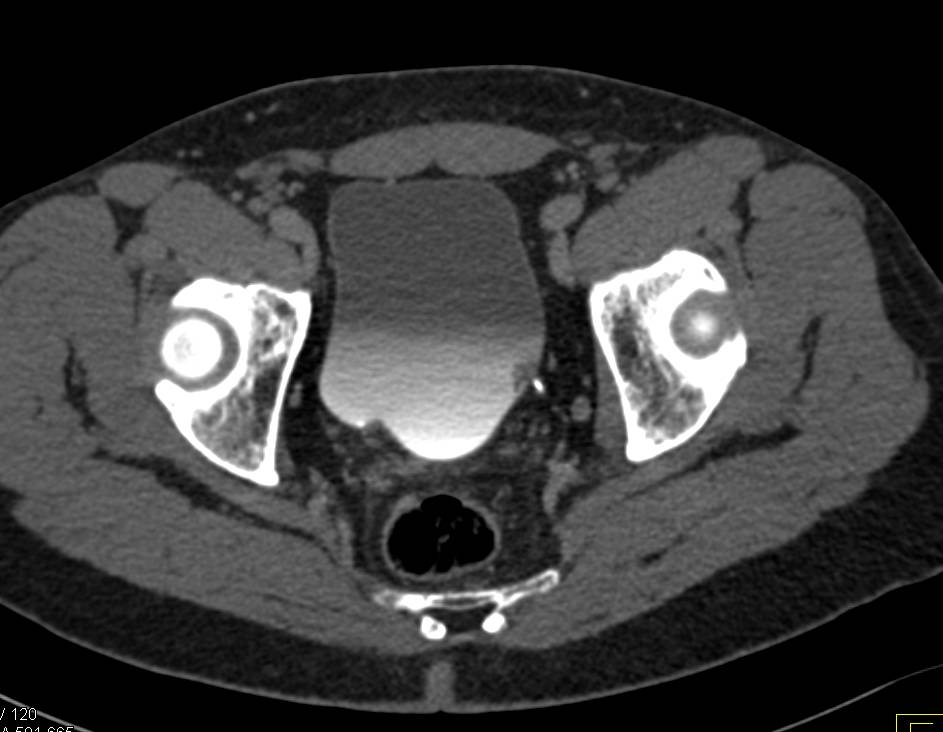 1 cm Bladder cancer Near Left Ureterovesical Junction (UVJ) - CTisus CT Scan