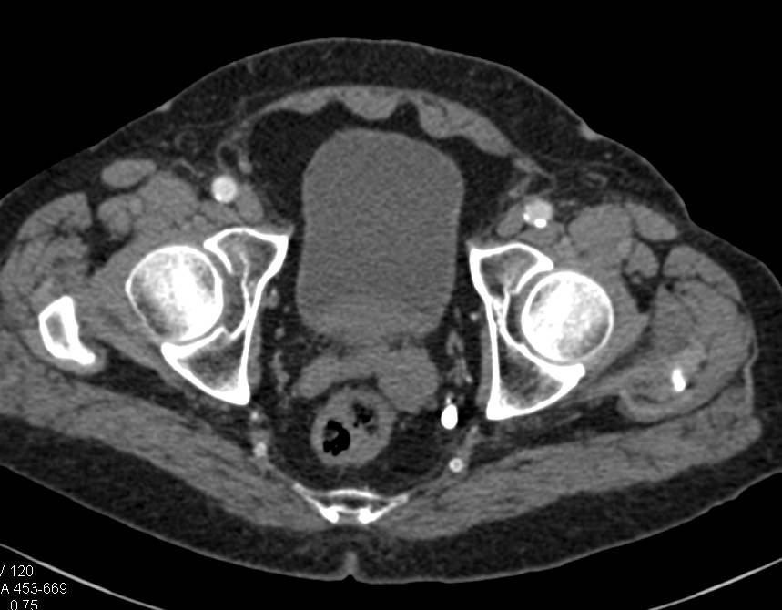 Prostate Cancer Involves the Left Seminal Vesicle - CTisus CT Scan