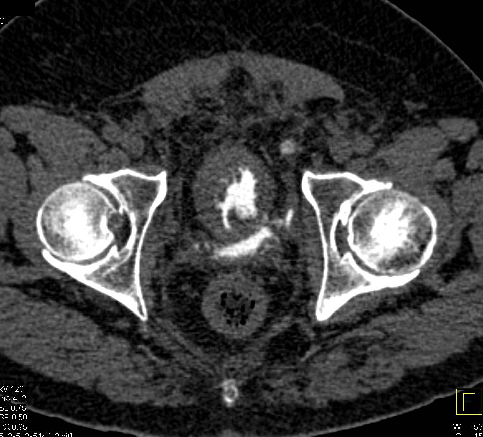 CT Cystogram Shows Extraperitoneal Bladder Rupture Following a Laparoscopic Prostatectomy - CTisus CT Scan