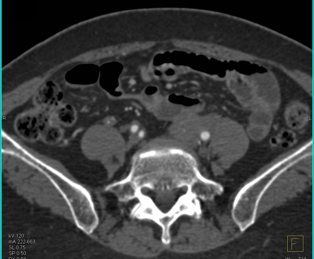 Retroperitoneal Fibrosis with Obstructed Left Kidney - CTisus CT Scan