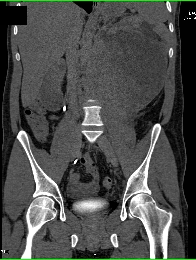 Retroperitoneal Liposarcoma with Minimal Macroscopic Fatty Elements - CTisus CT Scan