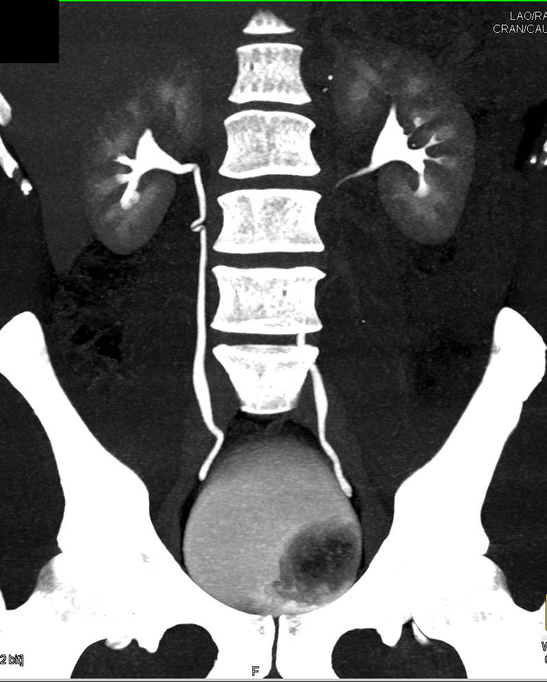 Mildly Enhancing Bladder Carcinoma - CTisus CT Scan