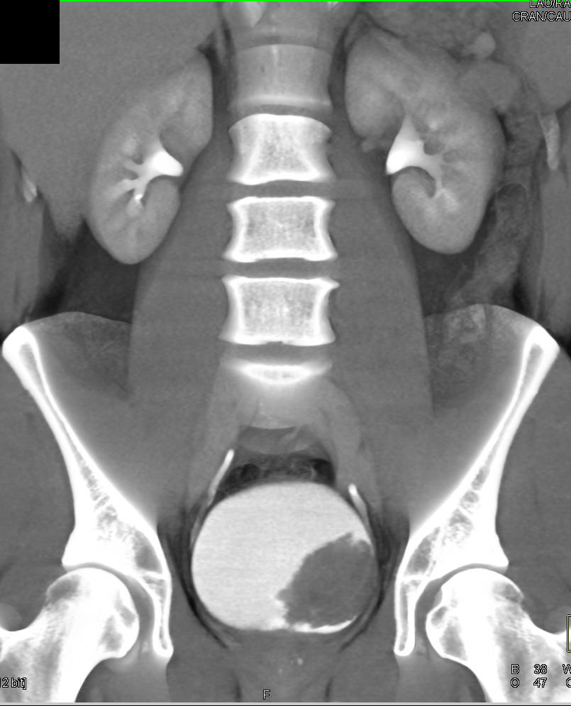 Mildly Enhancing Bladder Carcinoma - CTisus CT Scan