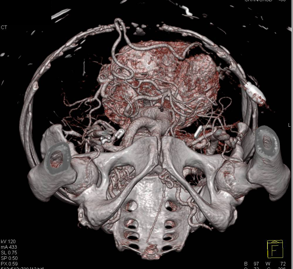 CTA with Peritoneal Dialysis Catheter - CTisus CT Scan