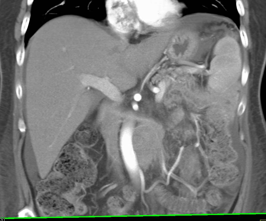 Obstructed Left Kidney with Carcinomatosis and Implants Left Upper Quadrant - CTisus CT Scan