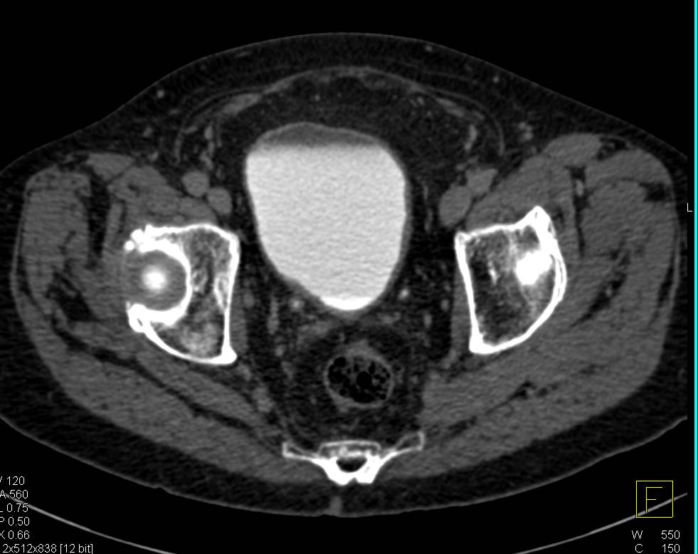 Bladder Extends into an Inguinal Hernia - CTisus CT Scan