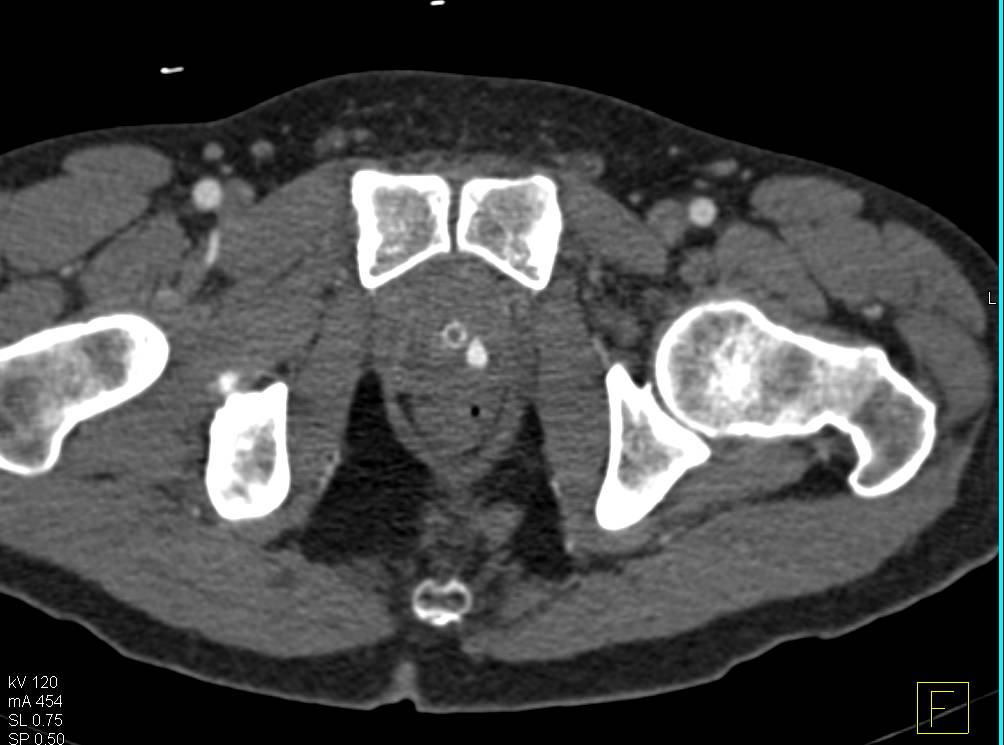 Active Bleed in the Base of the Bladder - CTisus CT Scan