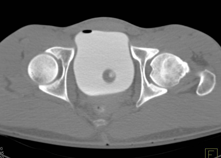 Normal CT Cystogram S/P GSW Pelvis - CTisus CT Scan