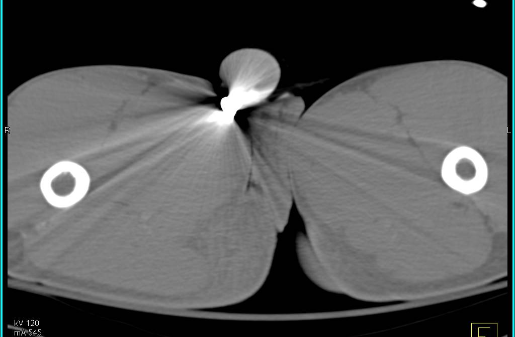 Normal CT Cystogram S/P Pelvic Trauma - CTisus CT Scan