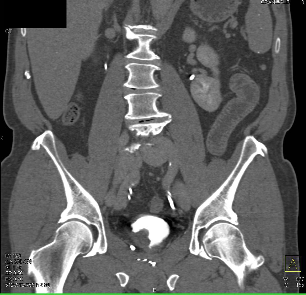 Bladder Cancer in 3D - CTisus CT Scan