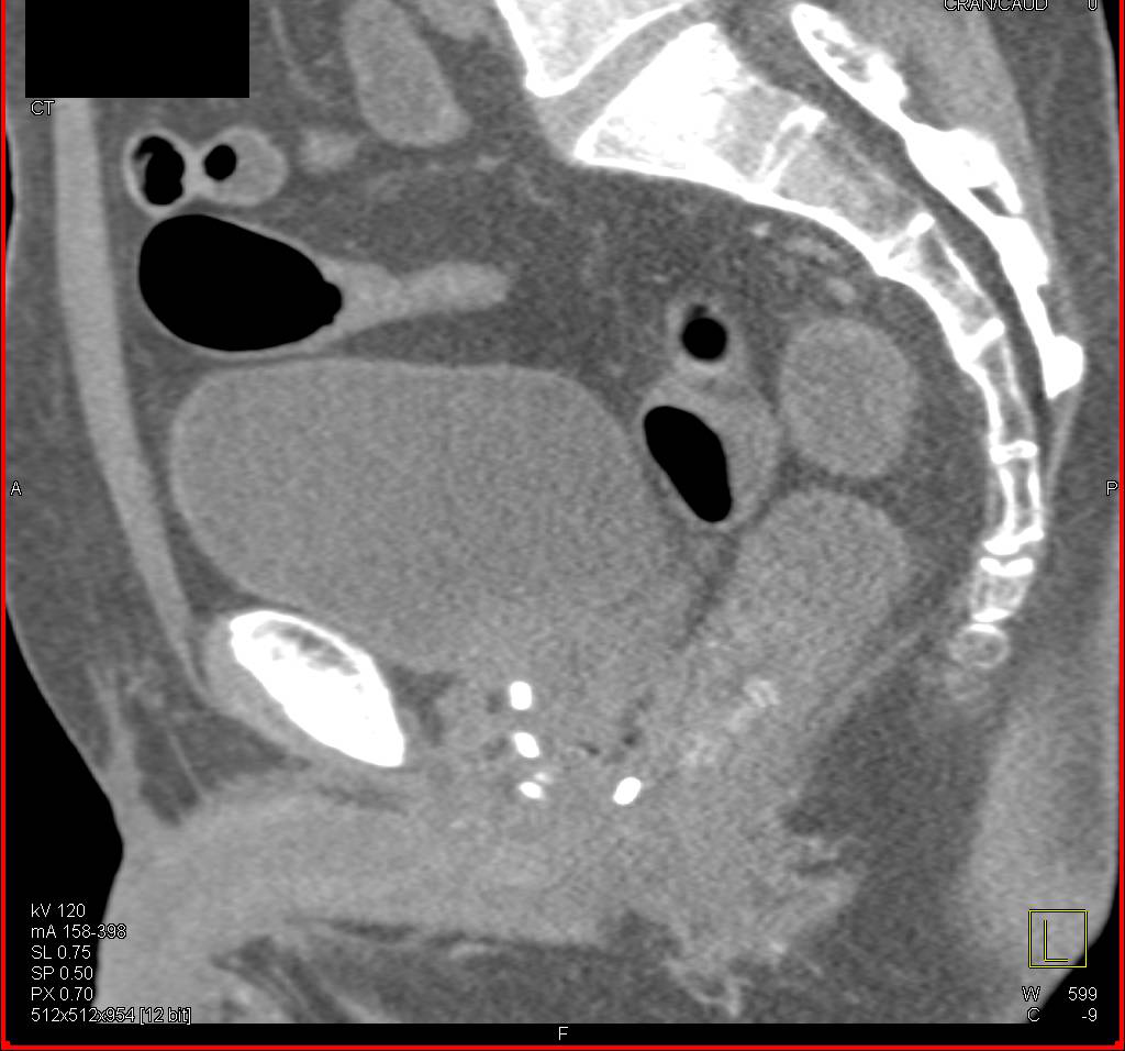 3D Imaging of Radioactive Seeds in the Prostate Gland for Treatment of Cancer - CTisus CT Scan