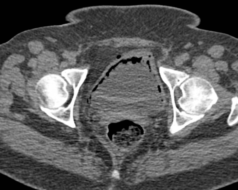 Emphysematous Cystitis - CTisus CT Scan