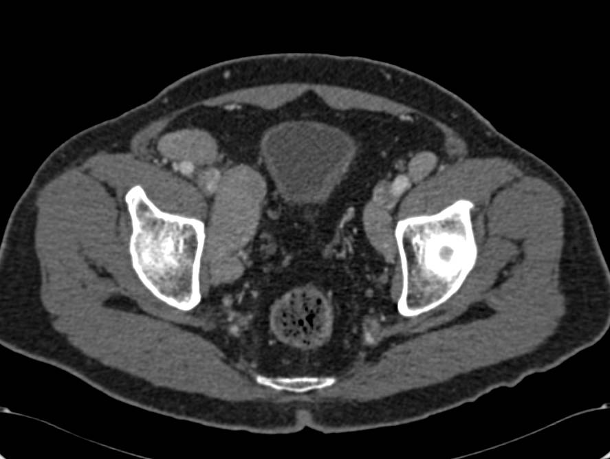 Bulky Pelvic Adenopathy Due to Gynecological Tumor - CTisus CT Scan