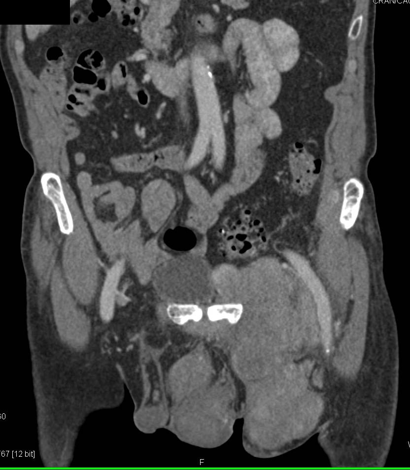 Penile Carcinoma with Bulky Adenopathy - CTisus CT Scan