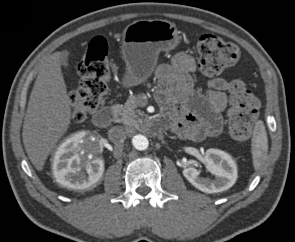 Perirenal Lymphoma Right Kidney - CTisus CT Scan