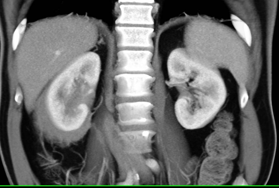 Perirenal Lymphoma Right Kidney - CTisus CT Scan