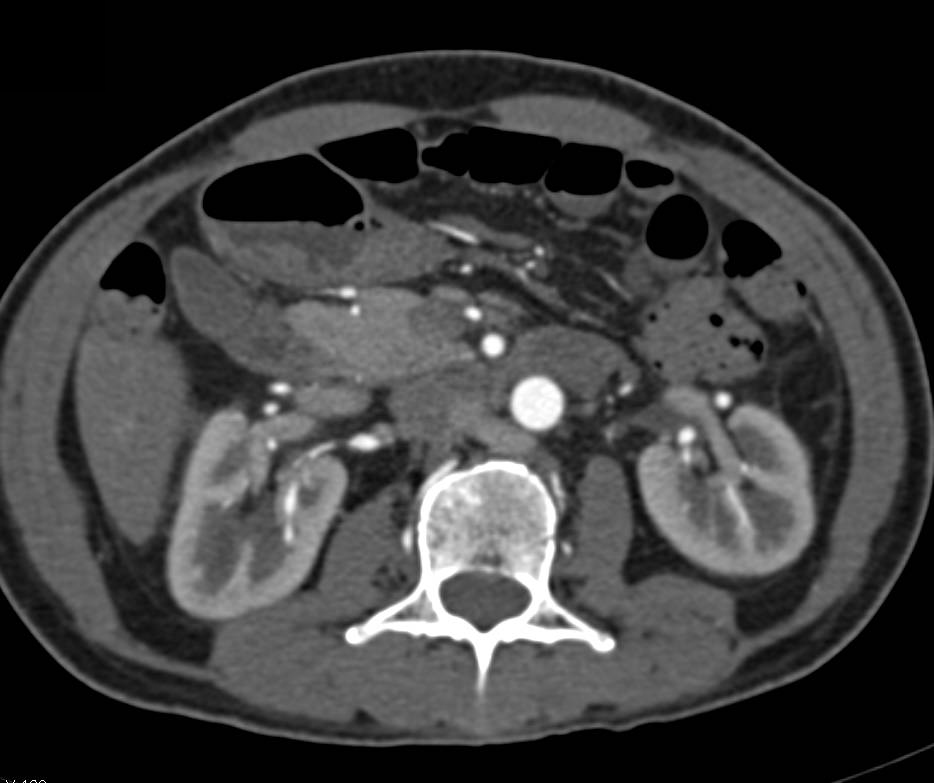 Tumor Infiltrates the Proximal Right Ureter - CTisus CT Scan