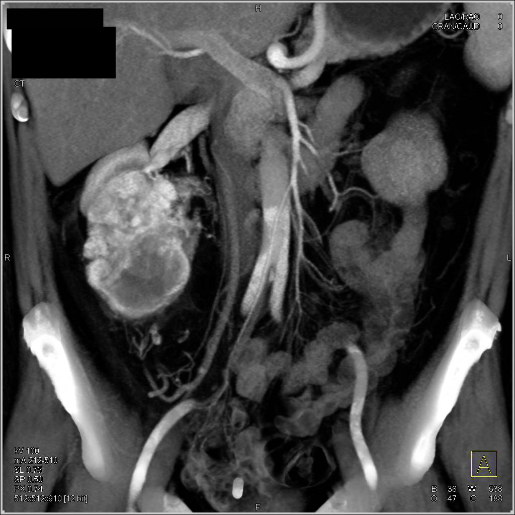 Renal Cell Carcinoma Looks a bit Like an Oncocytoma - CTisus CT Scan