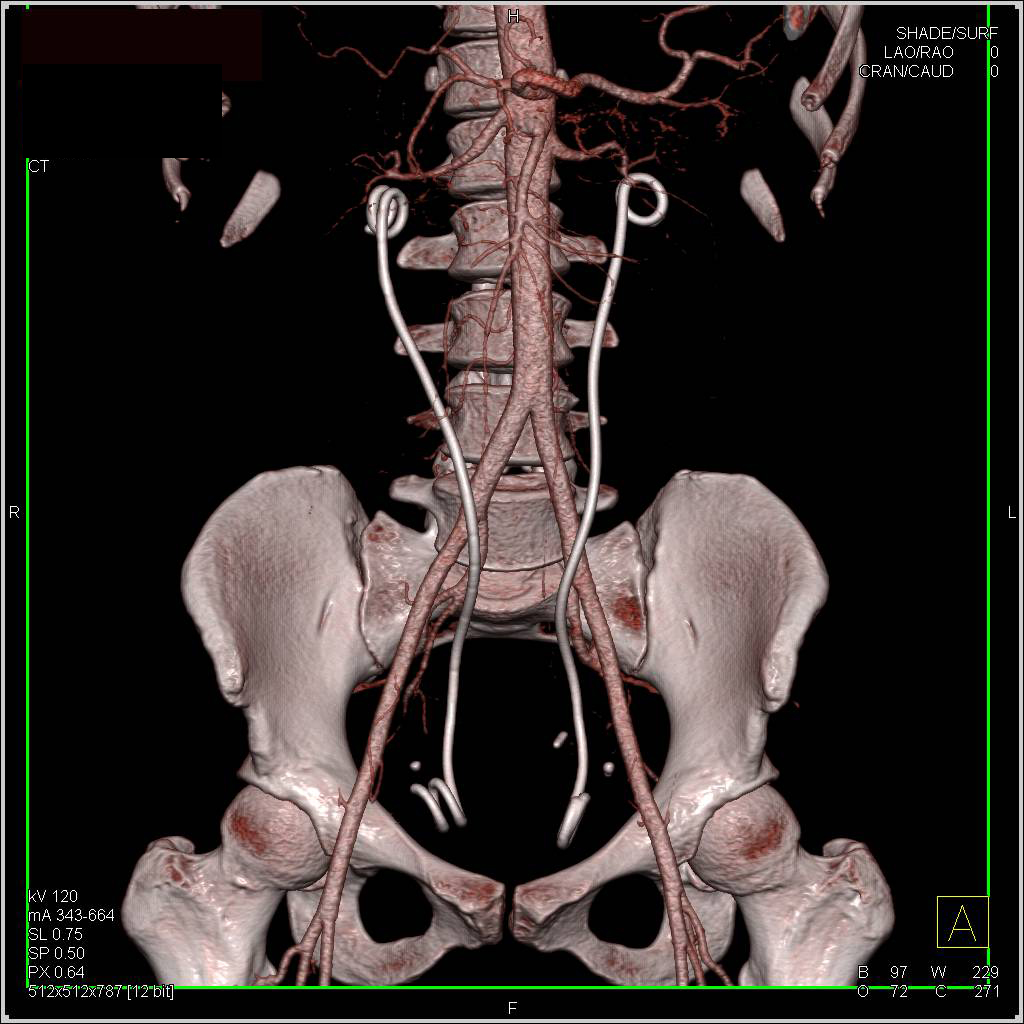 Stents in Ureters with Retroperitoneal Fibrosis - CTisus CT Scan