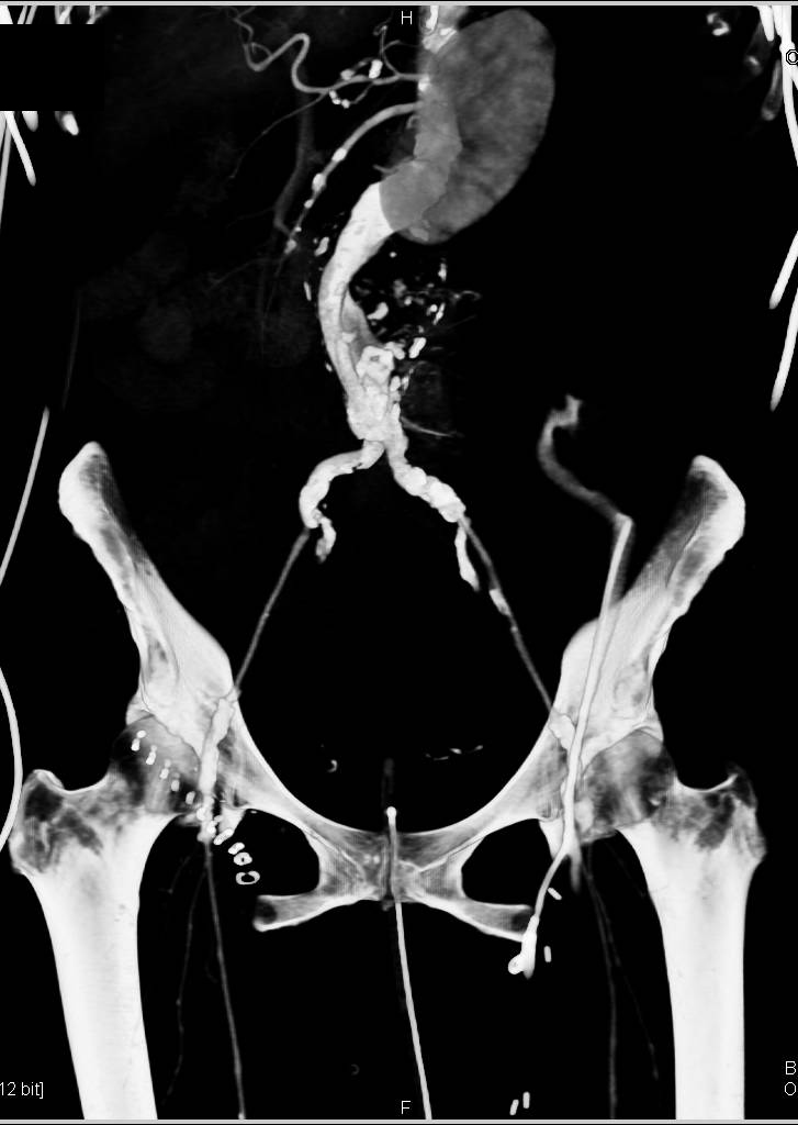 Left Retroperitoneal Hematoma - CTisus CT Scan