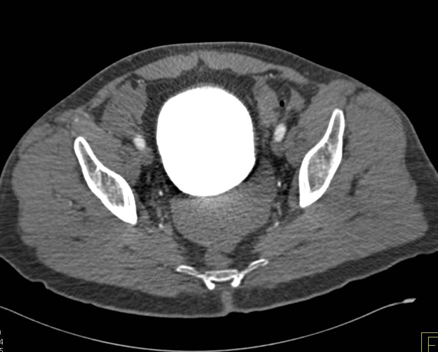 Intra-Abdominal Bleed - CTisus CT Scan