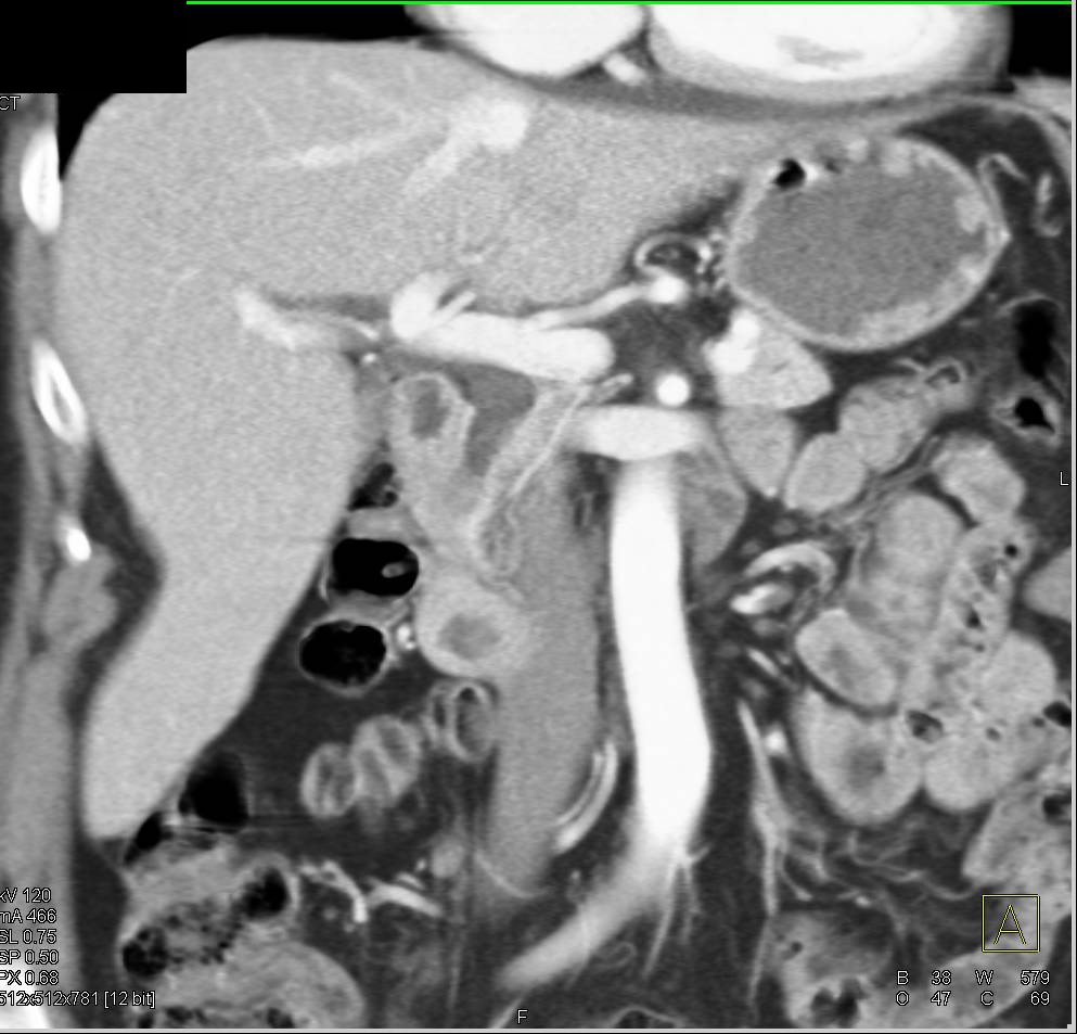 Nonopaque Stone Right Common Bile Duct (CBD), and Transitional Cell Cancer (TCC) Left Ureter - CTisus CT Scan