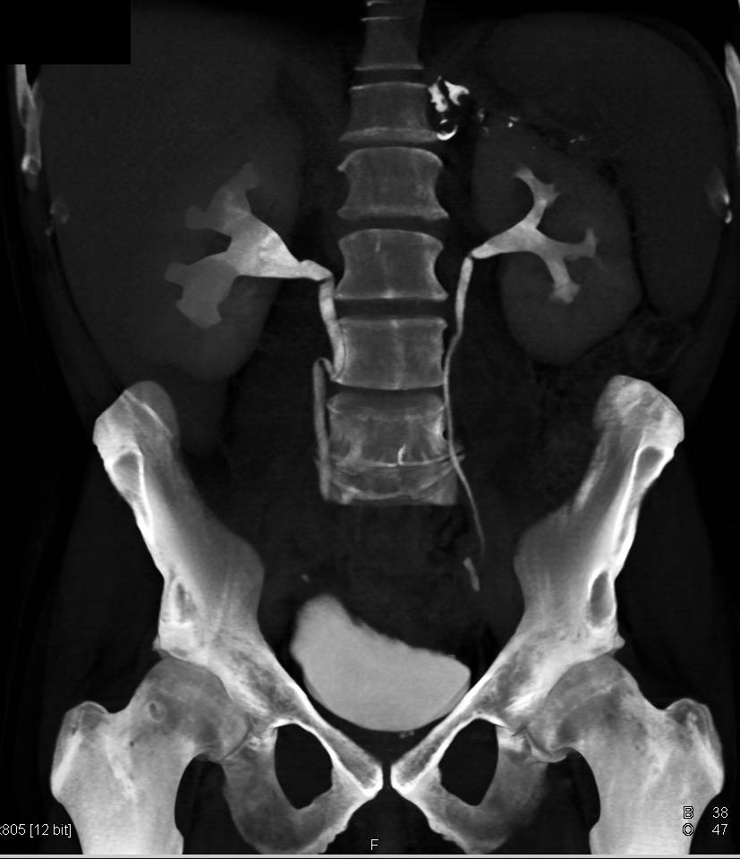 Bladder Cancer - CTisus CT Scan