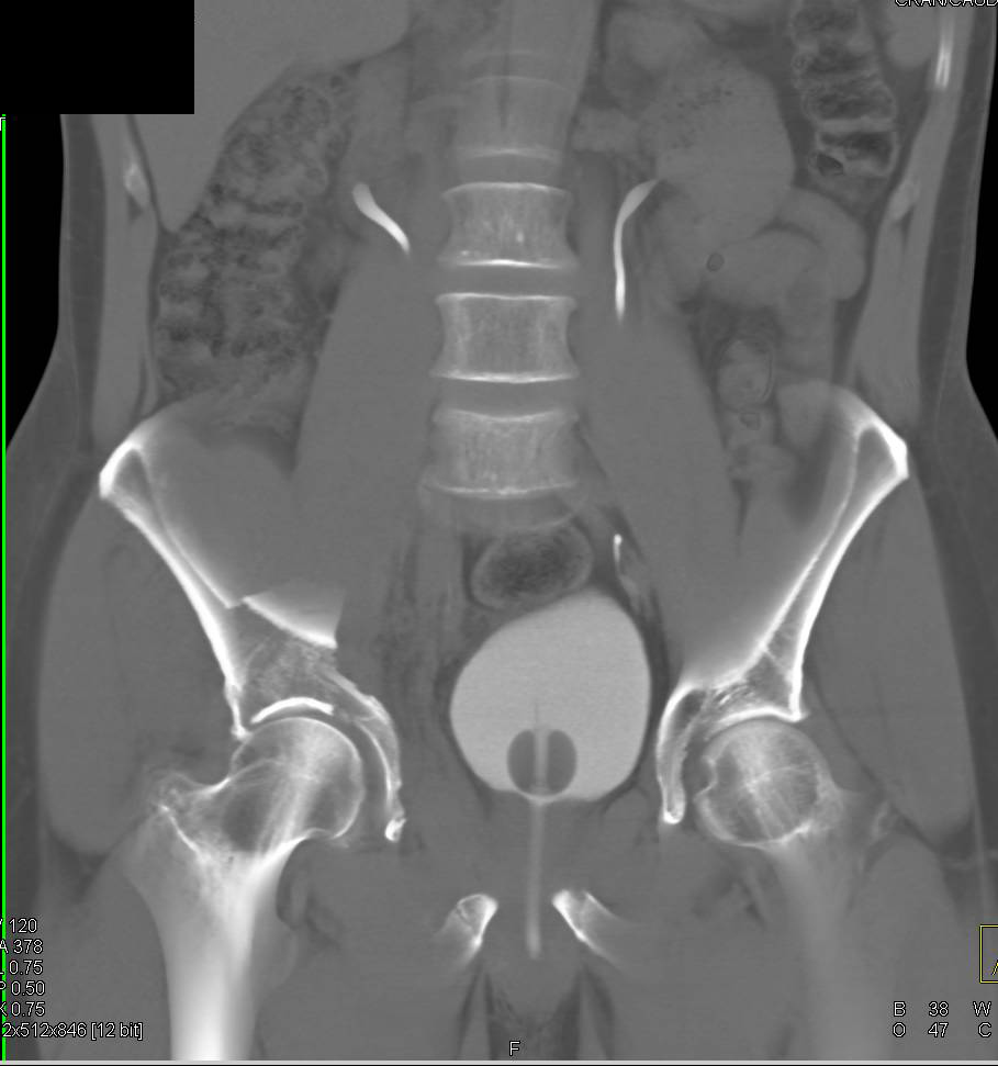 Pelvic and Acetabular Fractures with Normal CT Cystogram - CTisus CT Scan