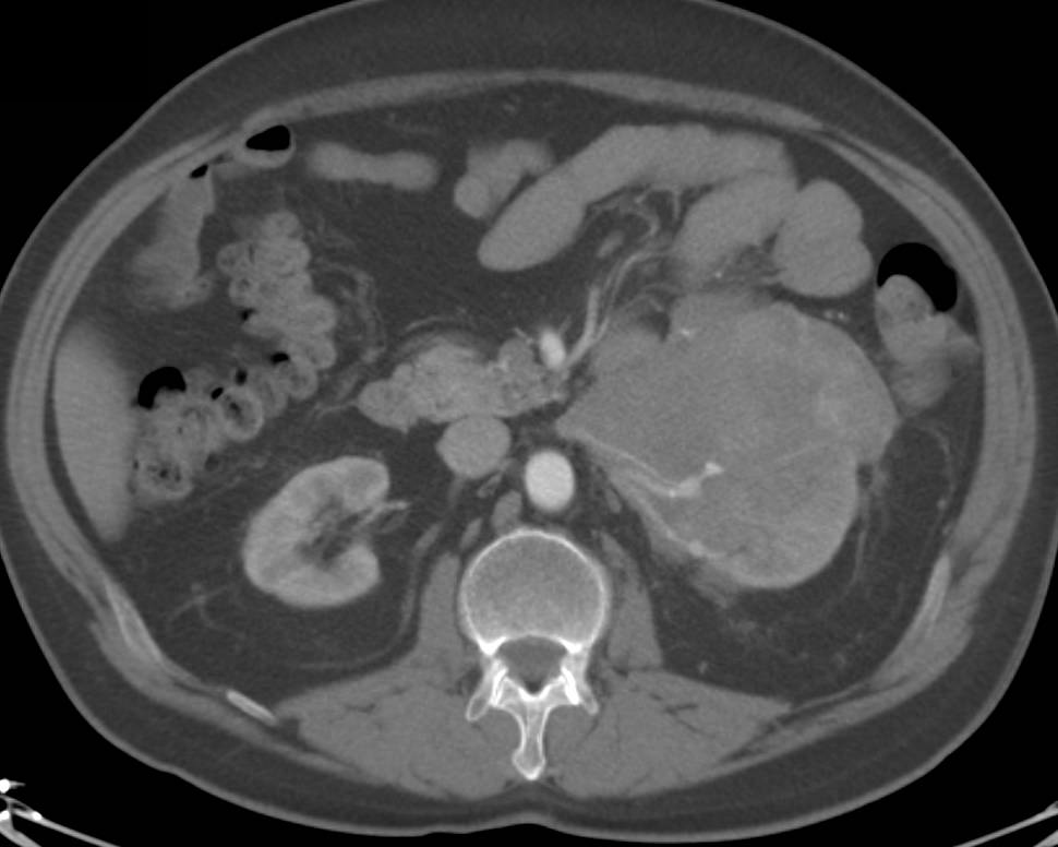 Infiltrating Left Renal Lymphoma - CTisus CT Scan