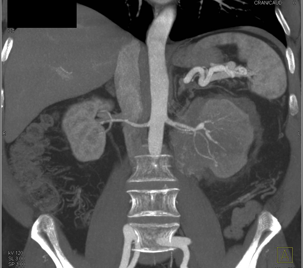 Renal Lymphoma with Peri and Pararenal Involvement - CTisus CT Scan