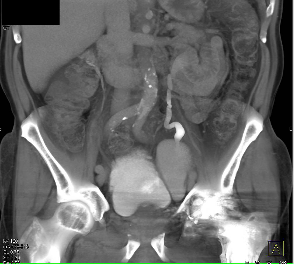 Multiple Bladder Diverticuli - CTisus CT Scan