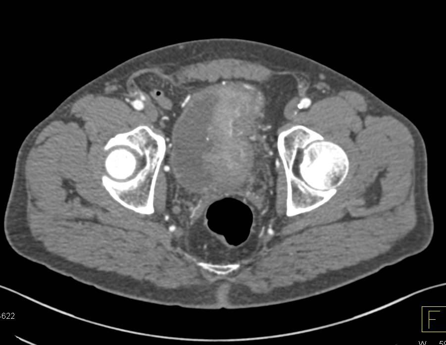 Incidental Large Bladder Cancer in a Patient Evaluated for Claudication - CTisus CT Scan