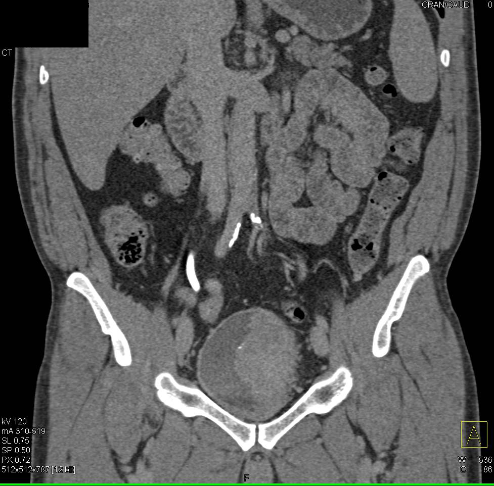 Large Bladder Cancer in a Patient with Vascular Disease - CTisus CT Scan